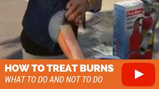 How to treat a first degree minor burn [upl. by Vander]