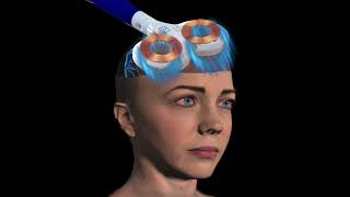 What is rTMS Repetitive Transcranial Magnetic Stimulation [upl. by Dat]