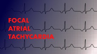 Focal Atrial Tachycardia  EKG Interpretation  MEDZCOOL [upl. by Pate605]