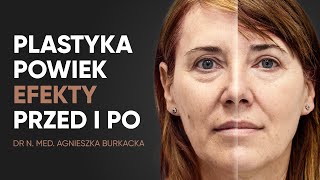 Plastyka powiek górnych blefaroplastyka  przed i po [upl. by Shaughnessy]