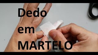 Dedo em Martelo  Tratamento conservador [upl. by Krucik]