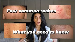 Four common rashes and everything you need to know about them [upl. by Vigor]