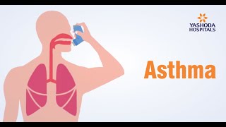 Asthma Symptoms amp Precautions amp Causes Bronchial Thermoplasty [upl. by Durwyn458]