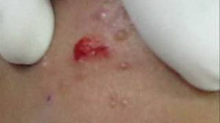 Treatment of Molluscum Contagiosumwmv [upl. by Lissak]