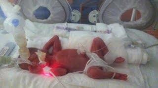 Born at 25 Weeks MicroPreemie Documentary [upl. by Dyke]