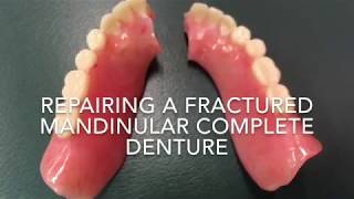 Repairing a fractured denture [upl. by Reginnej]