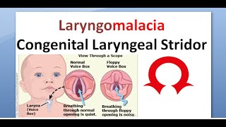 ENT 348 a Laryngomalacia congenital laryngeal stridor inspiratory [upl. by Yahsram]