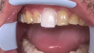 Houston Cosmetic DentistStep by step procedure for Porcelain VeneersConservative preps [upl. by Nahsaj]