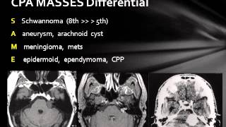 Cerebellopontine Angle Lesions [upl. by Egedan891]