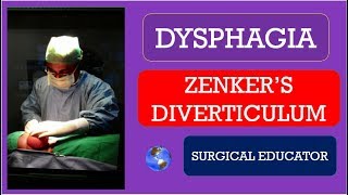 ZENKERS DIVERTICULUM  How To DIAGNOSE amp TREAT DYSPHAGIA [upl. by Dimitri526]