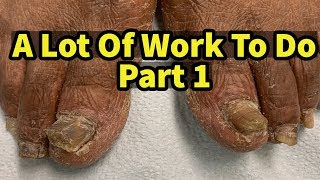 Severe Fungal Fungus Toenails A Lot Of Work To Do Part 1 [upl. by Subir]