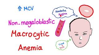 Nonmegaloblastic Macrocytic Anemia [upl. by Lunseth]