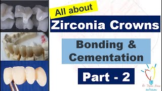 Zirconia Crowns  CEMENTATION vs BONDING [upl. by Porte]