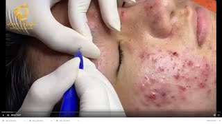 Treatment of acne tablets pustules and blackheads 359  Loan Nguyen [upl. by Nyrahs]