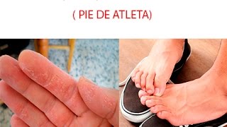 Como ELIMINAR los HONGOS de pies y manos COMPROBADO [upl. by Abehsat695]