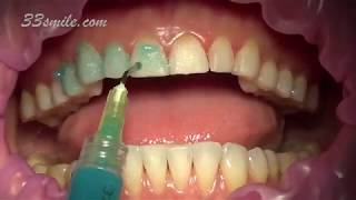 Prepless Veneers Permanent Teeth Whitening [upl. by Sirret]