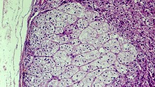 What is Hyperplasia  Pathology mini tutorial [upl. by Schwerin]