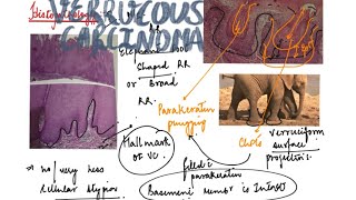 Verrucous carcinoma [upl. by Desi]