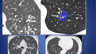 Signs of bronchiectasis [upl. by Iran]