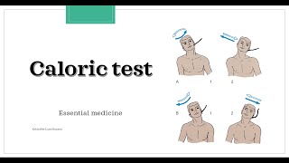 Caloric test Essential medicine [upl. by Arot]