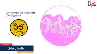 Verrucous carcinoma Histopathological features lets draw [upl. by Iah]