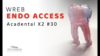 Endo Access 30 Acadental  Access Cavity Preparation for Molars [upl. by Atiekan]