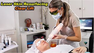 Laser Skin Resurfacing  by Clear Lift  Harmony XL Pro  best full demo  treatment fully explained [upl. by Ynabe]