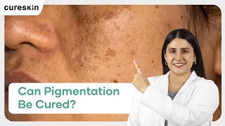 How Long Does It Take to Cure Pigmentation  Cureskin [upl. by Akeimat]