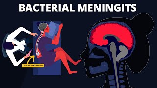 Bacterial Meningitis  Symptoms Diagnosis Treatments amp Pathology [upl. by Nevart861]