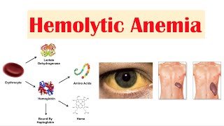 Hemolytic Anemia [upl. by Bonaparte]