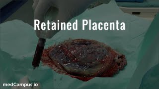 Retained Placenta Management [upl. by Chuu456]