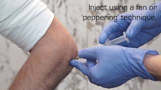 Injection Technique for Lateral Epicondylalgia [upl. by Nehtanoj]