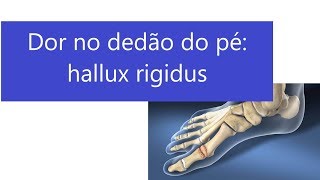 O dedão que dói hallux rigidus e artrose no pé [upl. by Citron]