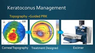 Keratoconus Management Corneal Crosslinking amp TopographyGuided PRK at Bochner Eye in Toronto [upl. by Aksoyn83]