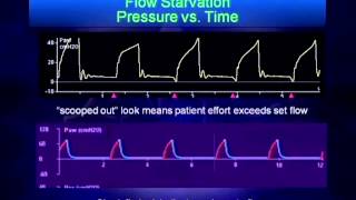 Mechanical Ventilation Waveform Analysis [upl. by Lockhart]