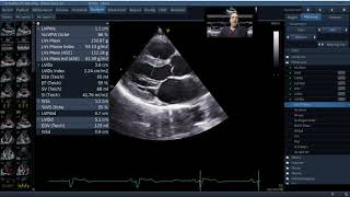 Standardisierte Echokardiographie  Normalbefund [upl. by Kenney860]