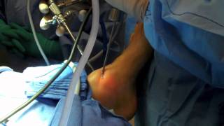 Ankle Arthroscopy [upl. by Jasmin]