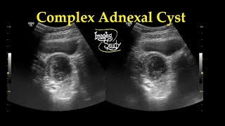 Hemorrhagic cyst  Medical Meaning [upl. by Klos]