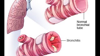 Bronchitis PEV [upl. by Olia]