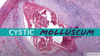 Molluscum Contagiosum cystic 5Minute Pathology Pearls [upl. by Annatsirhc]