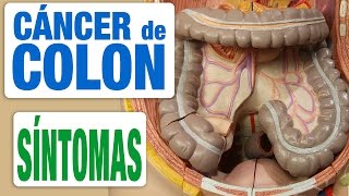 Cáncer de Colon  Síntomas [upl. by Yuhas]