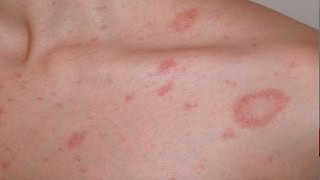 Pityriasis rosea English version [upl. by Magda49]