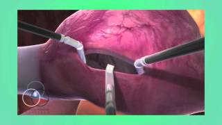 Atrial Septal Defect Repair at SSM Heart Institute [upl. by Naujid]