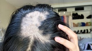 Im going bald  Alopecia Areata What I did to grow my hair [upl. by Gwenny]