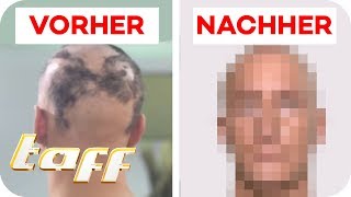 Kreisrunder Haarausfall nach Unfall Kann man das retten  SOS  Einsatz der BeautyRetter  taff [upl. by Aynom]