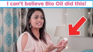 Bio Oil Review Benefits Uses  MomJunction Hacks [upl. by Horacio812]