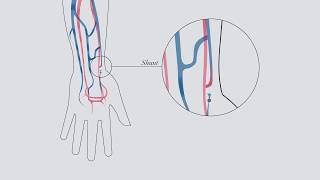 Understanding hemodialysis [upl. by Chas]