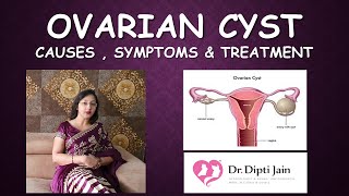 OVARIAN CYST  CAUSES SYMPTOMS amp TREATMENT [upl. by Assirral]