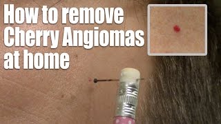 How to remove Red Skin Dots at home Quick amp Easy Cherry Angioma treatment [upl. by Ravahs]