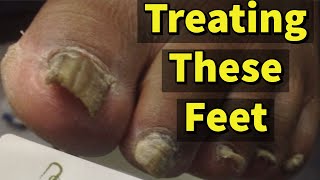 Treating These Feet A Patient With Fungal Toenails [upl. by Eelarac]